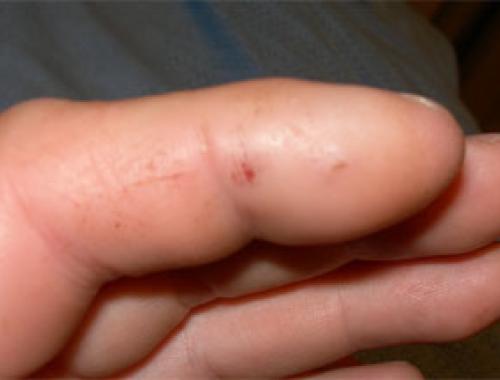 sanke bite